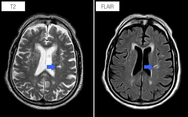 End-Stage White Matter Disease