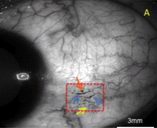 What causes microangiopathic changes in white matter