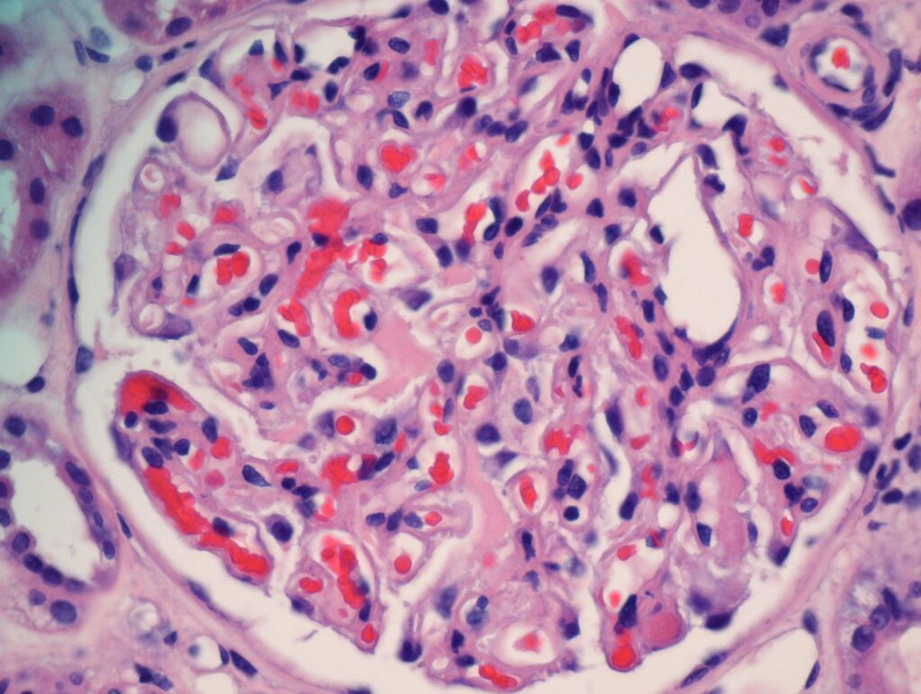 Microangiopathy Treatment! - Students Room