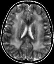 Moderate White Matter Changes