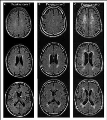 Severe White Matter Changes