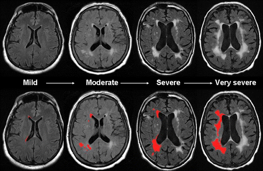 What are the treatment options for white matter disease