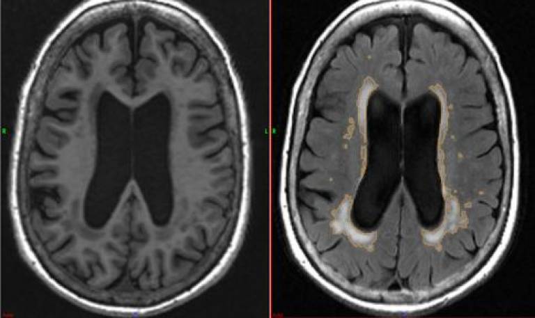 Mild White Matter Changes