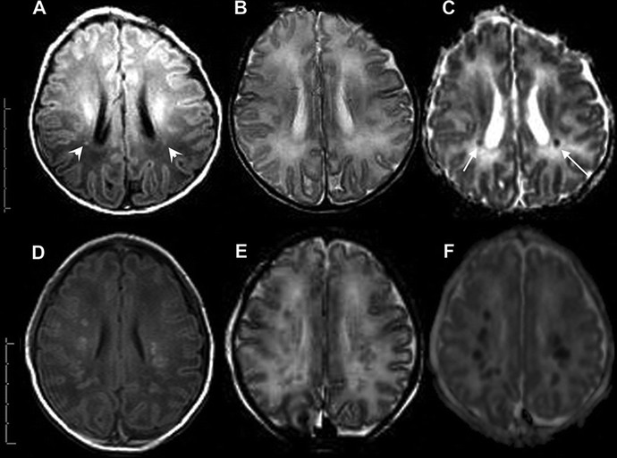 How does white matter disease progress and what symptoms are associated with it