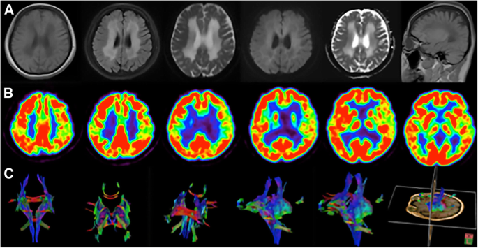 White Matter Disease Life Expectancy