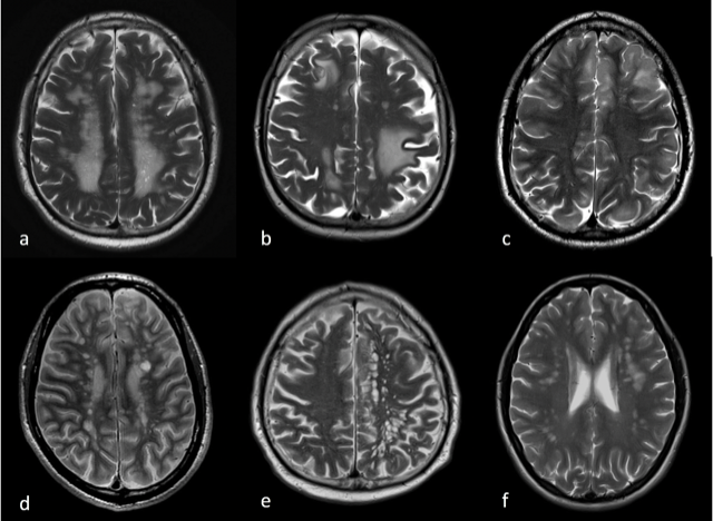 How is white matter disease diagnosed and what is the prognosis